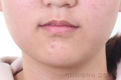 연산동치아교정