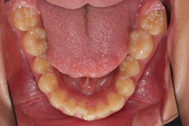 부산비발치교정