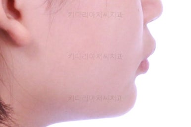 부산어린이치아교정