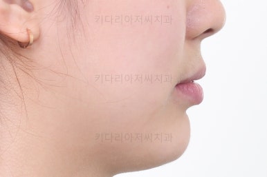 부산안면비대칭