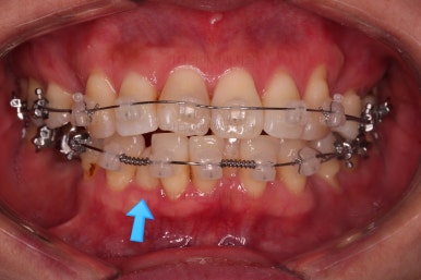 동래임플란트교정