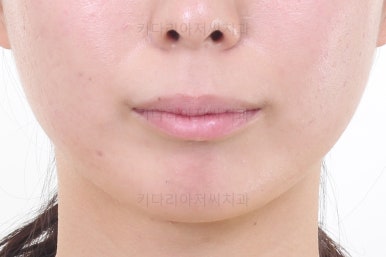 부산무턱교정치과