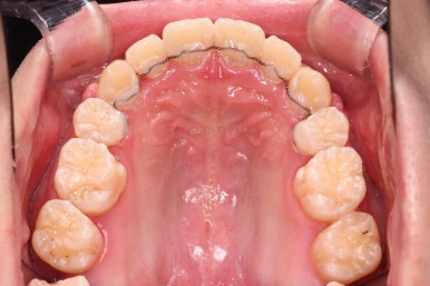 부산돌출입교정