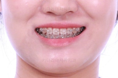 부산치아교정잘하는곳