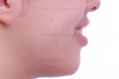 부산투명교정