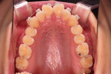 부산앞니부분교정