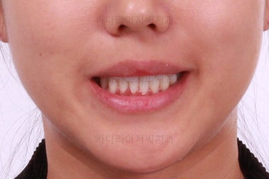 부산치아교정잘하는곳