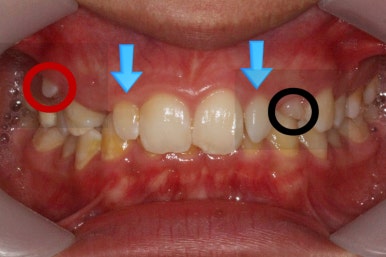 부산왜소치교정