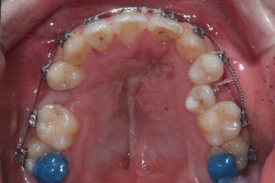 부산구순구개열