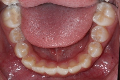 연산동덧니교정