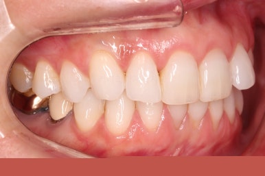 연산동부분교정