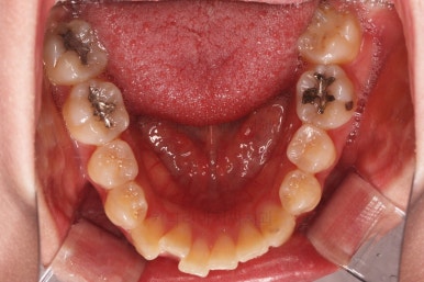 부산비대칭교정