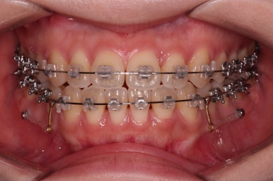 부산치아교정추천