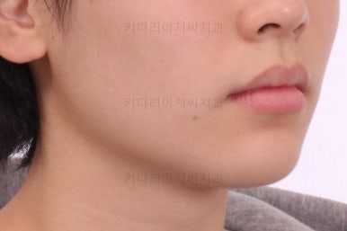 부산연산동치아교정