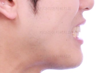 연산동치아교정