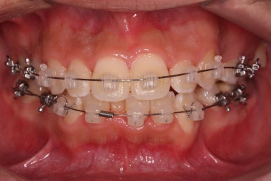 부산청소년치아교정