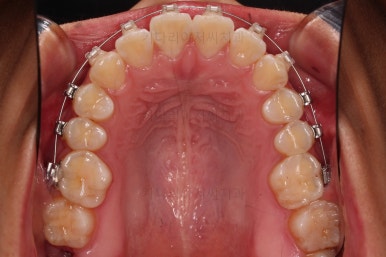 부산연산역치아교정