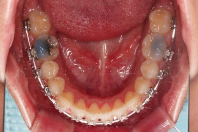 부산비발치교정