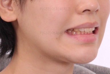 부산연산동치아교정