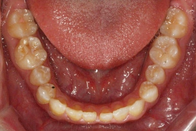 부산왜소치교정