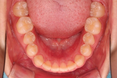 부산앞니벌어짐교정