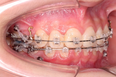 연산동치아교정
