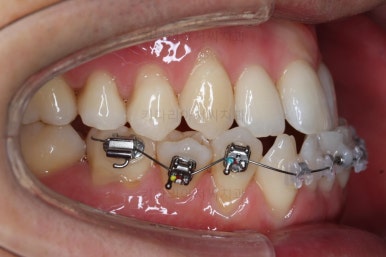 부산비수술교정