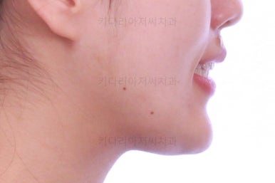 부산비발치교정