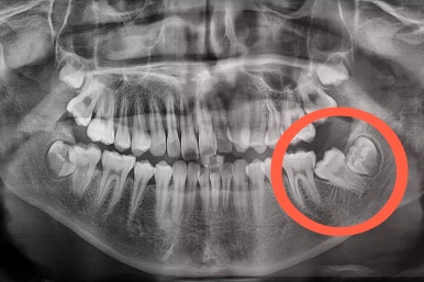 부산연산동사랑니발치