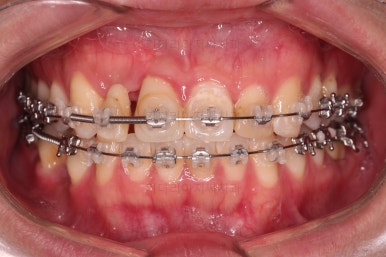 연산동치아교정