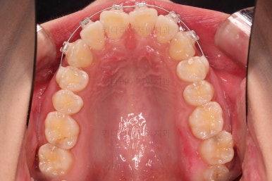 부산앞니부분교정