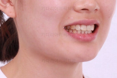 부산앞니부분교정