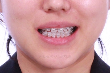 부산치아교정잘하는곳