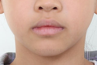 부산어린이반대교합
