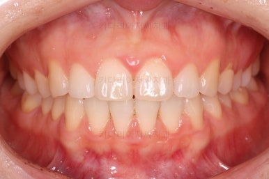 부산나비앞니교정