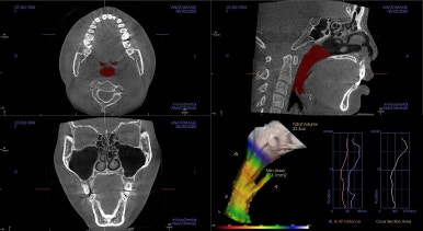 부산구순구개열