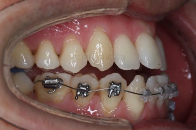 부산비수술교정