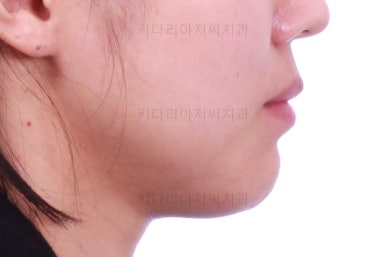 부산치아교정잘하는곳