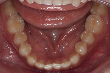 부산매복치아교정