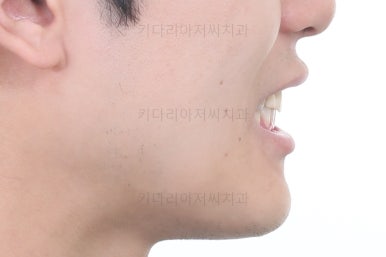 연산동치아교정