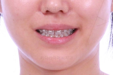 부산치아교정잘하는곳