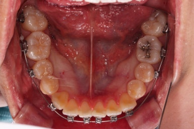 부산치아교정잘하는치과