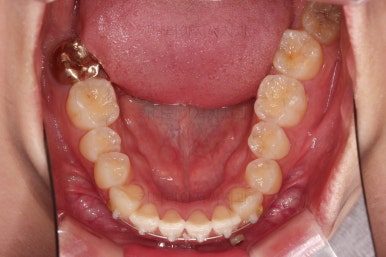 부산앞니부분교정