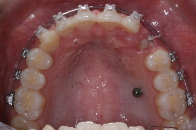 부산매복치아교정