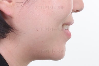 부산치아교정잘하는곳