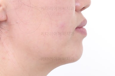 부산치아교정잘하는곳