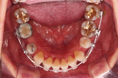 동래임플란트교정