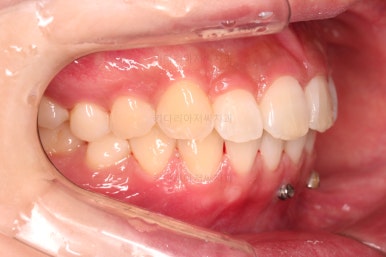 부산앞니부분교정