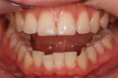 부산연산동교정치과