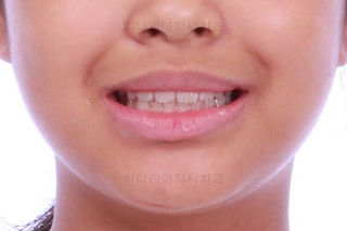 부산소아교정